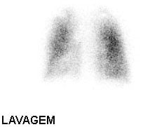 VQ scan - PAHVinverted